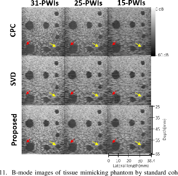 Figure 3 for Phase Aberration Robust Beamformer for Planewave US Using Self-Supervised Learning