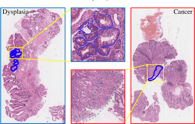 Figure 1 for RMDL: Recalibrated multi-instance deep learning for whole slide gastric image classification