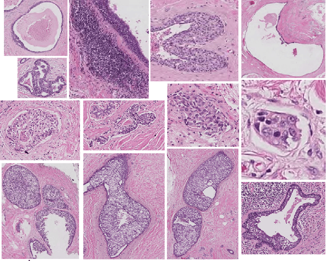 Figure 3 for An End-to-End Breast Tumour Classification Model Using Context-Based Patch Modelling- A BiLSTM Approach for Image Classification