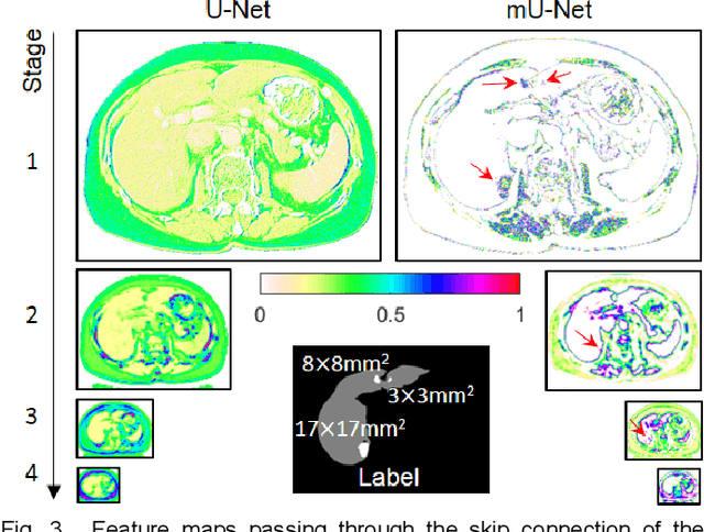Figure 4 for Modified U-Net  with Incorporation of Object-Dependent High Level Features for Improved Liver and Liver-Tumor Segmentation in CT Images