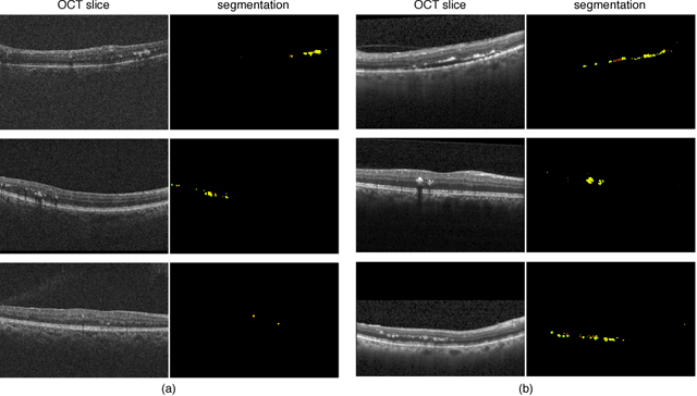 Figure 3 for Fully Automated Segmentation of Hyperreflective Foci in Optical Coherence Tomography Images