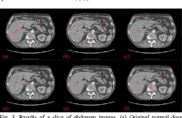Figure 3 for Low-dose CT denoising with convolutional neural network