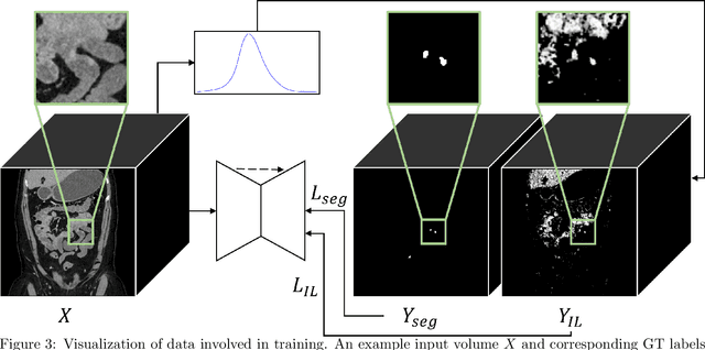 Figure 4 for Improving Small Lesion Segmentation in CT Scans using Intensity Distribution Supervision: Application to Small Bowel Carcinoid Tumor