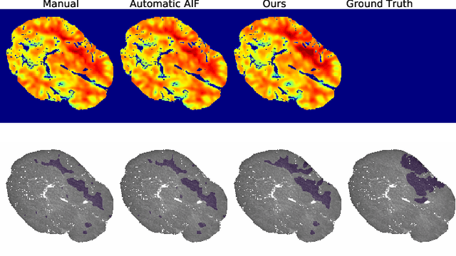Figure 3 for Differentiable Deconvolution for Improved Stroke Perfusion Analysis
