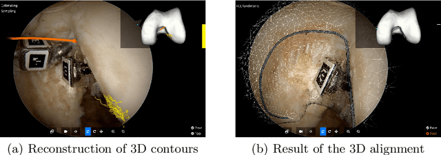 Figure 1 for Video-based computer aided arthroscopy for patient specific reconstruction of the Anterior Cruciate Ligament