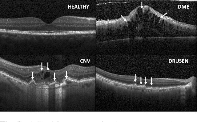 Figure 3 for Multi-Modal Learning Using Physicians Diagnostics for Optical Coherence Tomography Classification
