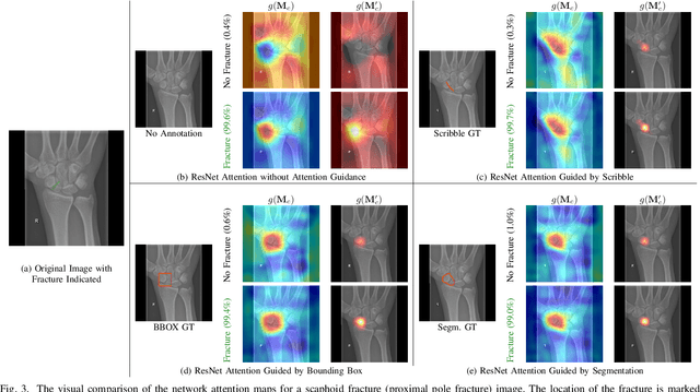 Figure 3 for CNN Attention Guidance for Improved Orthopedics Radiographic Fracture Classification