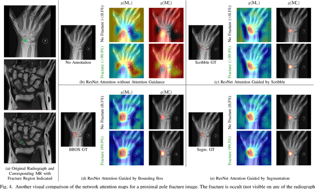 Figure 4 for CNN Attention Guidance for Improved Orthopedics Radiographic Fracture Classification