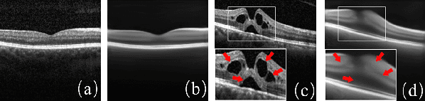 Figure 1 for Sparse-GAN: Sparsity-constrained Generative Adversarial Network for Anomaly Detection in Retinal OCT Image