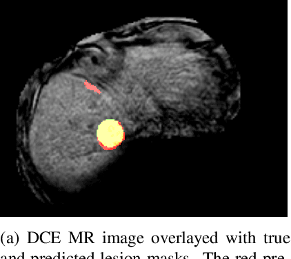 Figure 3 for Using uncertainty estimation to reduce false positives in liver lesion detection