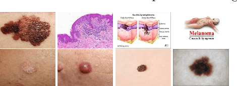 Figure 3 for Webly Supervised Learning for Skin Lesion Classification