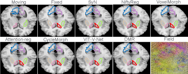 Figure 4 for Deformer: Towards Displacement Field Learning for Unsupervised Medical Image Registration