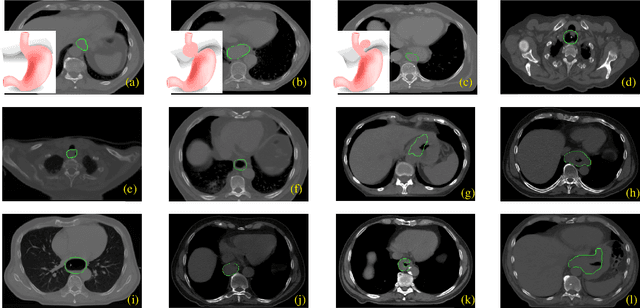 Figure 1 for Esophageal Tumor Segmentation in CT Images using a 3D Convolutional Neural Network