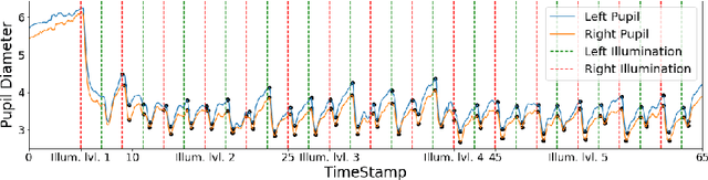 Figure 3 for VR-SFT: Reproducing Swinging Flashlight Test in Virtual Reality to Detect Relative Afferent Pupillary Defect