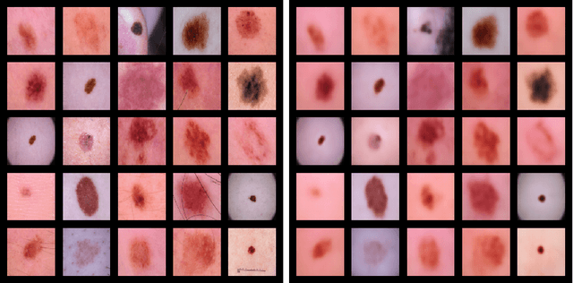 Figure 2 for Anomaly Detection for Skin Disease Images Using Variational Autoencoder
