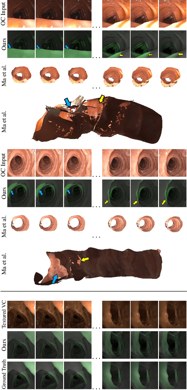 Figure 3 for Visualizing Missing Surfaces In Colonoscopy Videos using Shared Latent Space Representations
