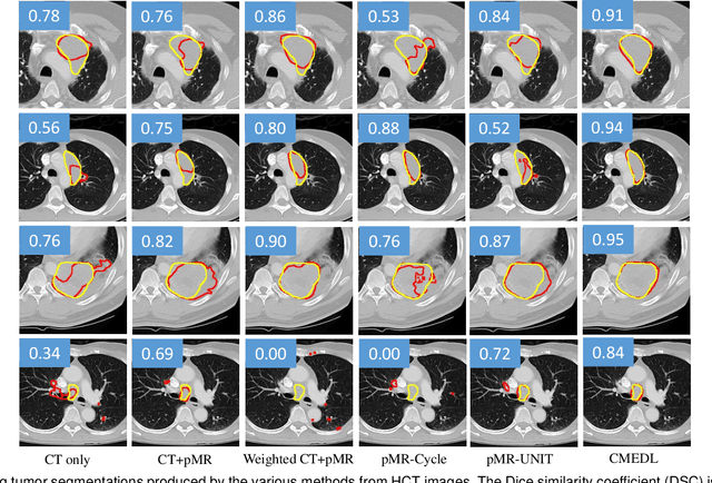 Figure 4 for Unpaired cross-modality educed distillation (CMEDL) applied to CT lung tumor segmentation