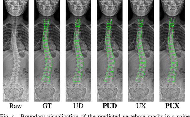 Figure 4 for Analysis of Scoliosis From Spinal X-Ray Images