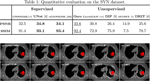 Figure 2 for ADN: Artifact Disentanglement Network for Unsupervised Metal Artifact Reduction