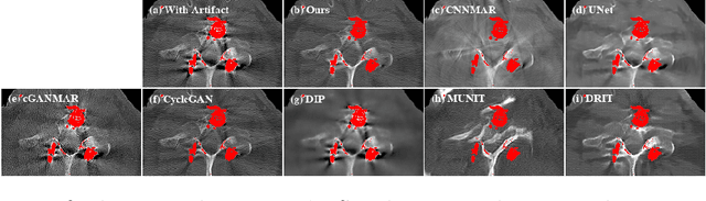 Figure 3 for ADN: Artifact Disentanglement Network for Unsupervised Metal Artifact Reduction