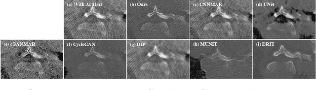 Figure 4 for ADN: Artifact Disentanglement Network for Unsupervised Metal Artifact Reduction