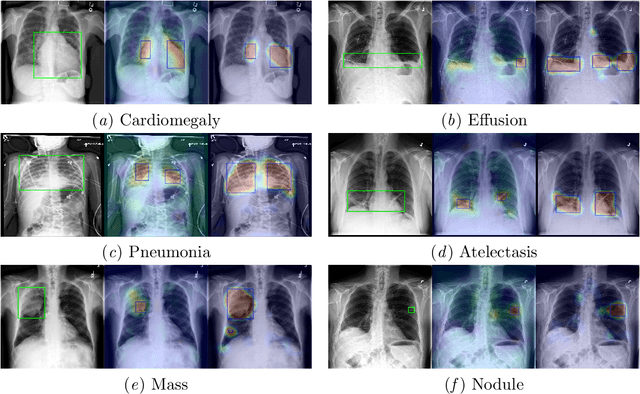 Figure 3 for Weakly Supervised Lesion Localization With Probabilistic-CAM Pooling