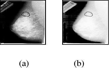 Figure 3 for Automatic Application Level Set Approach in Detection Calcifications in Mammographic Image