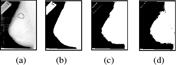 Figure 4 for Automatic Application Level Set Approach in Detection Calcifications in Mammographic Image