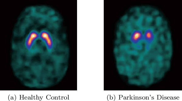 Figure 3 for An Explainable Machine Learning Model for Early Detection of Parkinson's Disease using LIME on DaTscan Imagery