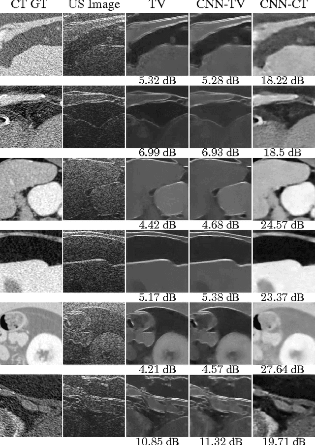 Figure 4 for Towards CT-quality Ultrasound Imaging using Deep Learning