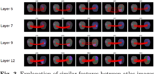 Figure 4 for Improving a neural network model by explanation-guided training for glioma classification based on MRI data
