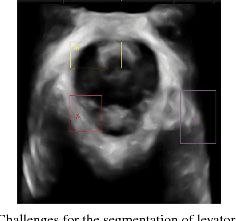 Figure 1 for Segmentation of Levator Hiatus Using Multi-Scale Local Region Active contours and Boundary Shape Similarity Constraint