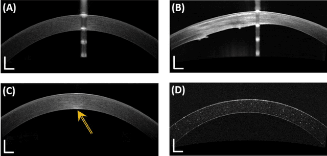 Figure 1 for Objective assessment of corneal transparency in the clinical setting with standard SD-OCT devices