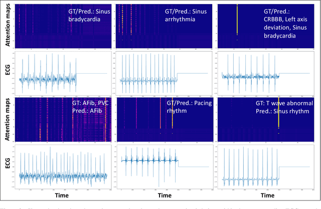 Figure 4 for Convolution-Free Waveform Transformers for Multi-Lead ECG Classification