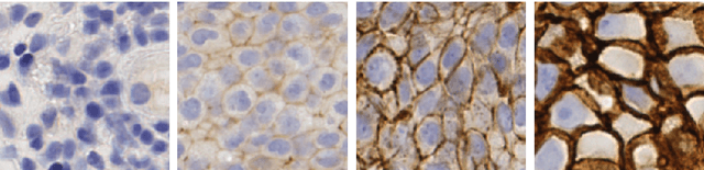 Figure 1 for An Automatic Patch-based Approach for HER-2 Scoring in Immunohistochemical Breast Cancer Images Using Color Features