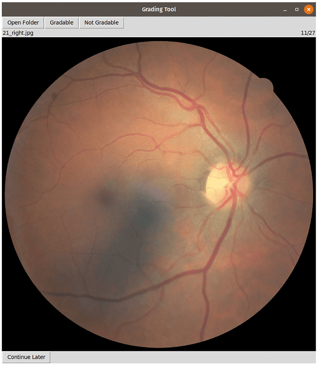 Figure 3 for Replication study: Development and validation of deep learning algorithm for detection of diabetic retinopathy in retinal fundus photographs