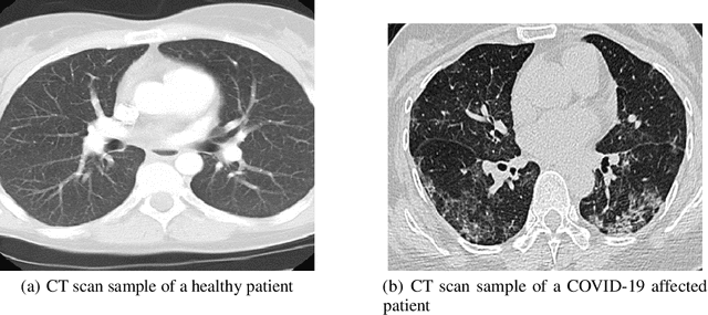 Figure 2 for Comparative performance analysis of the ResNet backbones of Mask RCNN to segment the signs of COVID-19 in chest CT scans