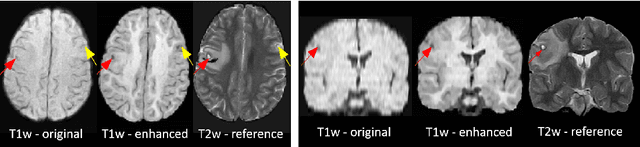 Figure 3 for Image Quality Transfer Enhances Contrast and Resolution of Low-Field Brain MRI in African Paediatric Epilepsy Patients