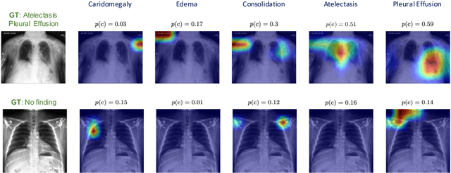 Figure 4 for Self-Training with Improved Regularization for Few-Shot Chest X-Ray Classification