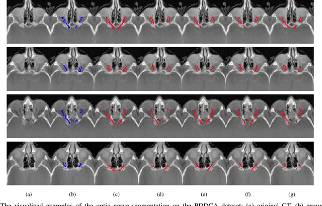 Figure 2 for Supervised Segmentation with Domain Adaptation for Small Sampled Orbital CT Images