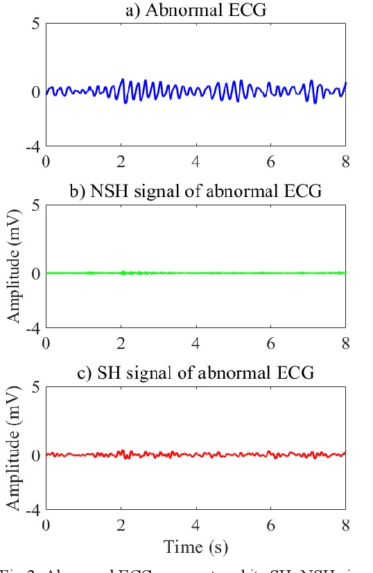 Figure 4 for K-Nearest Neighbors based Shock Advice Algorithm for Automated External Defibrillators