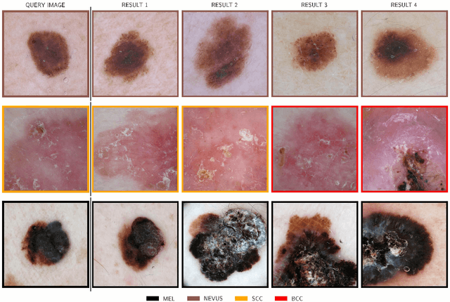 Figure 1 for Diagnostic Accuracy of Content Based Dermatoscopic Image Retrieval with Deep Classification Features
