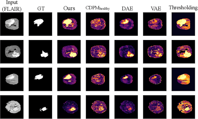 Figure 4 for What is Healthy? Generative Counterfactual Diffusion for Lesion Localization