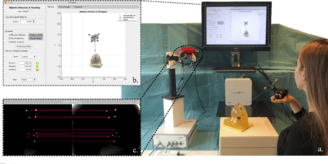 Figure 1 for Image-guided Breast Biopsy of MRI-visible Lesions with a Hand-mounted Motorised Needle Steering Tool