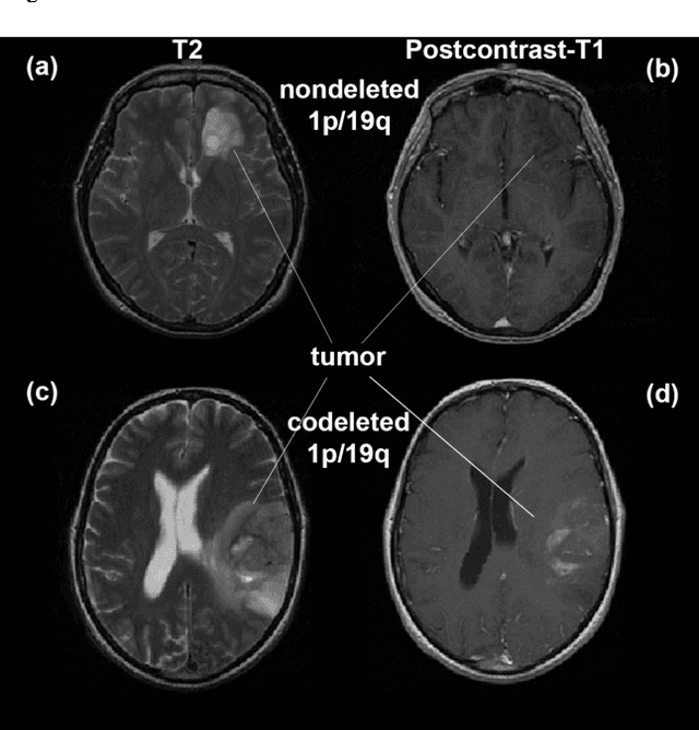 Figure 1 for Predicting 1p19q Chromosomal Deletion of Low-Grade Gliomas from MR Images using Deep Learning