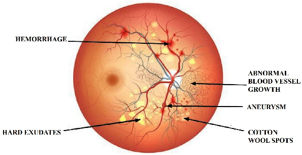 Figure 1 for Blindness (Diabetic Retinopathy) Severity Scale Detection