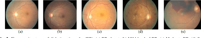 Figure 2 for Blindness (Diabetic Retinopathy) Severity Scale Detection