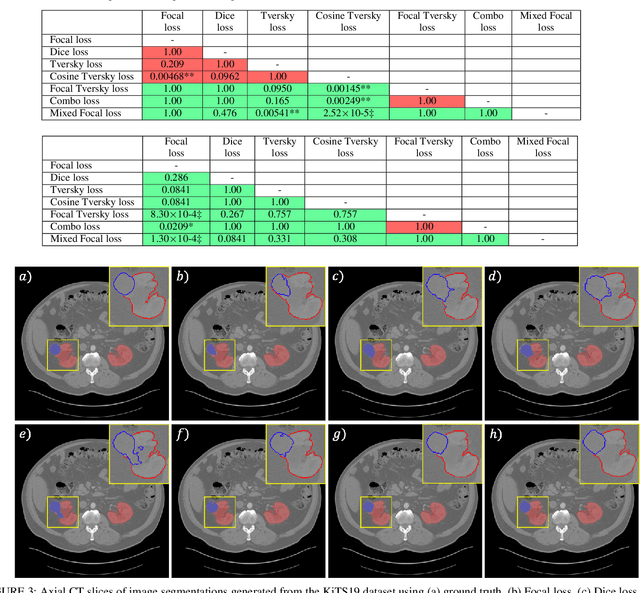 Figure 4 for A Mixed Focal Loss Function for Handling Class Imbalanced Medical Image Segmentation