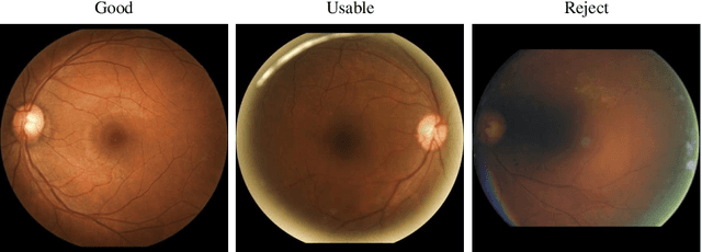Figure 1 for A Deep Retinal Image Quality Assessment Network with Salient Structure Priors