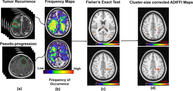 Figure 1 for Can tumor location on pre-treatment MRI predict likelihood of pseudo-progression versus tumor recurrence in Glioblastoma? A feasibility study